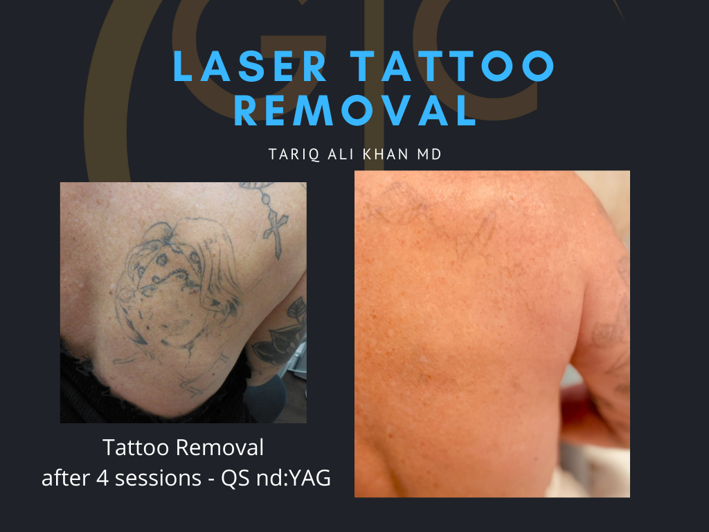 Gentle Care Laser Tustin & Long Beach Before and After picture - Tattoo Removal Mucosal Surface